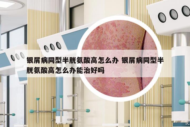 银屑病同型半胱氨酸高怎么办 银屑病同型半胱氨酸高怎么办能治好吗