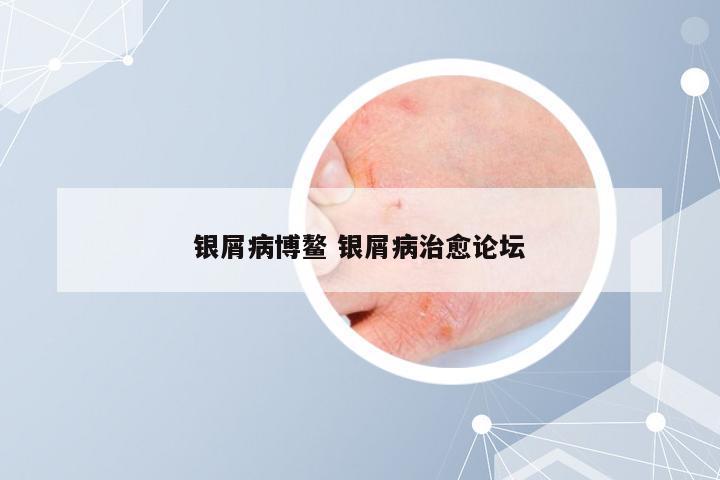 银屑病博鳌 银屑病治愈论坛