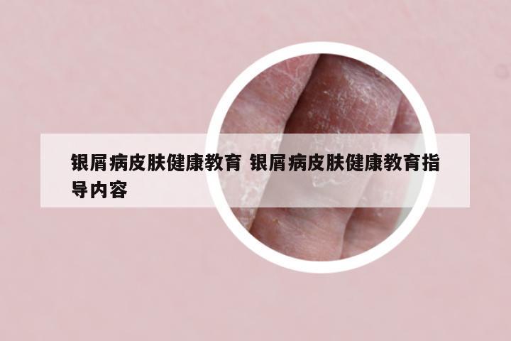 银屑病皮肤健康教育 银屑病皮肤健康教育指导内容