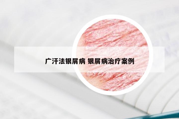 广汗法银屑病 银屑病治疗案例