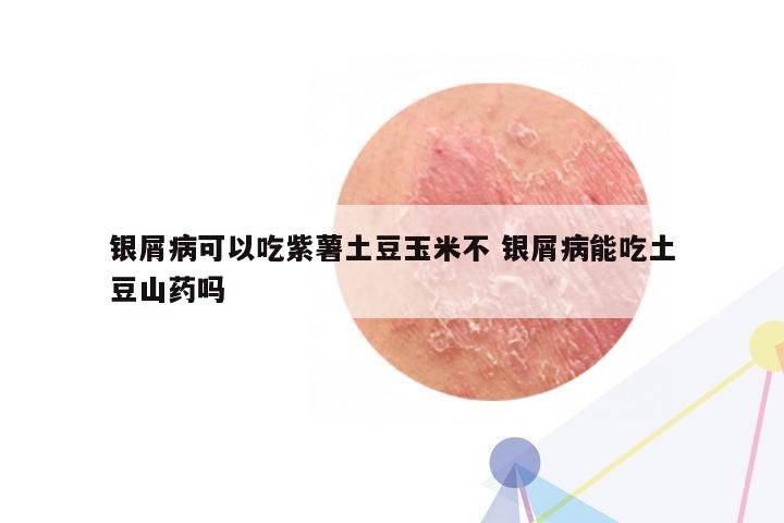 银屑病可以吃紫薯土豆玉米不 银屑病能吃土豆山药吗