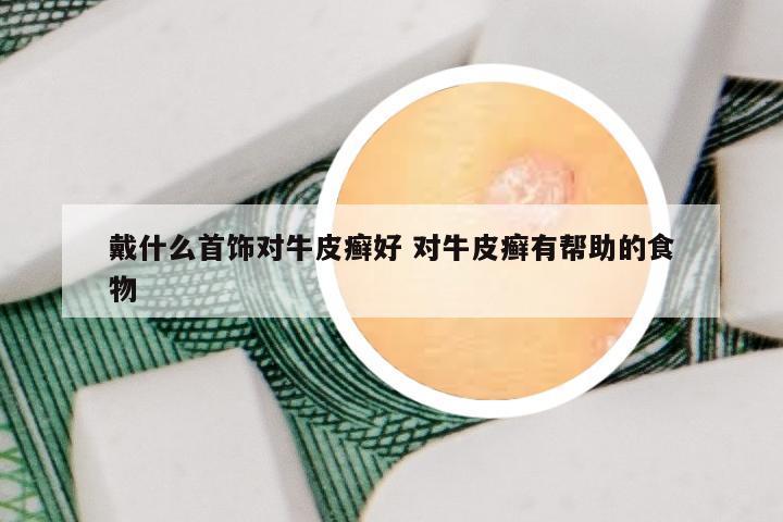 戴什么首饰对牛皮癣好 对牛皮癣有帮助的食物