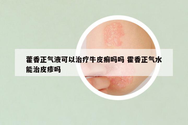 藿香正气液可以治疗牛皮癣吗吗 霍香正气水能治皮疹吗
