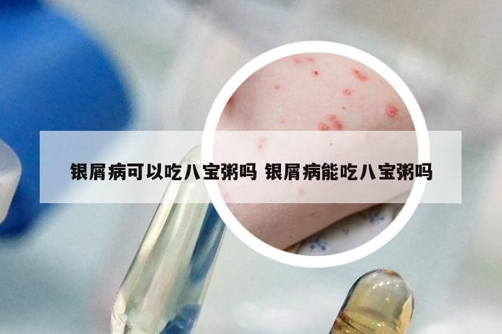 银屑病可以吃八宝粥吗 银屑病能吃八宝粥吗
