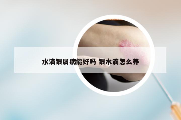 水滴银屑病能好吗 银水滴怎么养