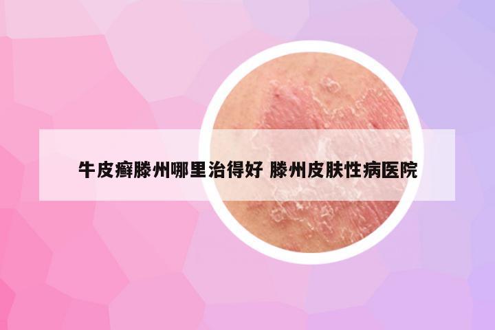 牛皮癣滕州哪里治得好 滕州皮肤性病医院