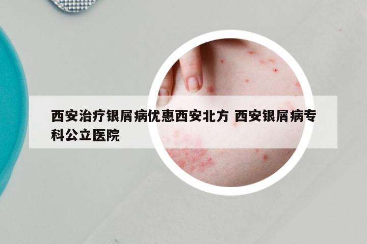 西安治疗银屑病优惠西安北方 西安银屑病专科公立医院