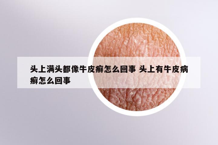 头上满头都像牛皮癣怎么回事 头上有牛皮病癣怎么回事