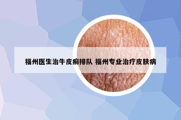 福州医生治牛皮癣排队 福州专业治疗皮肤病