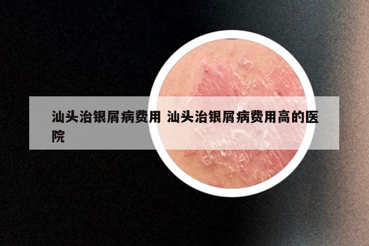 汕头治银屑病费用 汕头治银屑病费用高的医院