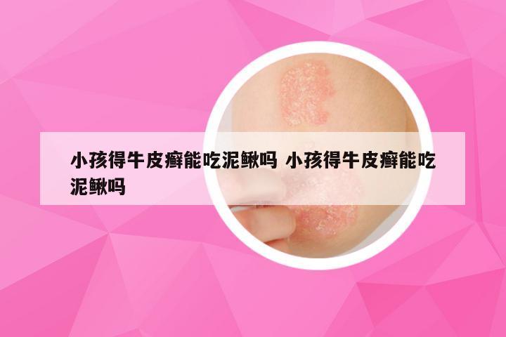 小孩得牛皮癣能吃泥鳅吗 小孩得牛皮癣能吃泥鳅吗