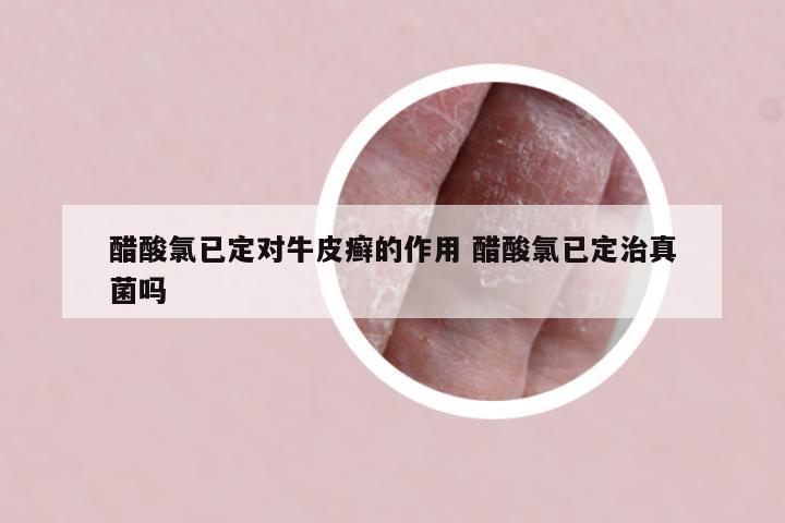 醋酸氯已定对牛皮癣的作用 醋酸氯已定治真菌吗