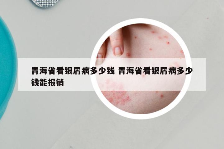 青海省看银屑病多少钱 青海省看银屑病多少钱能报销