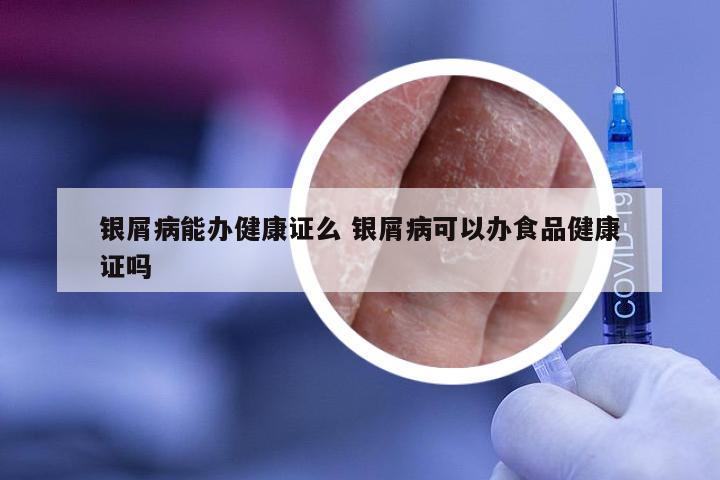 银屑病能办健康证么 银屑病可以办食品健康证吗