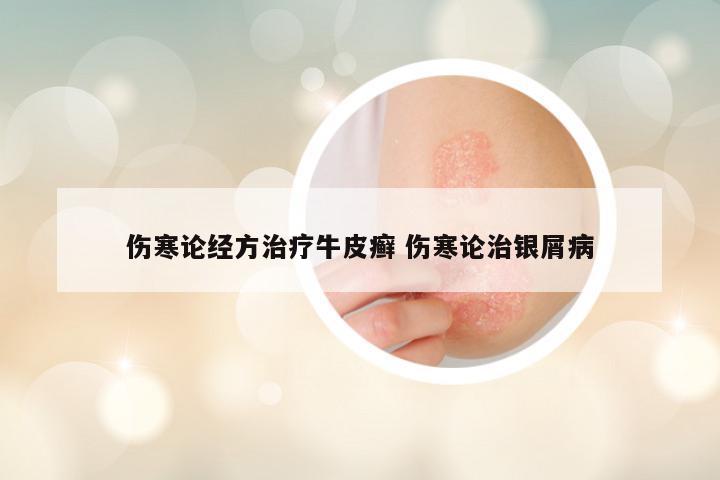 伤寒论经方治疗牛皮癣 伤寒论治银屑病