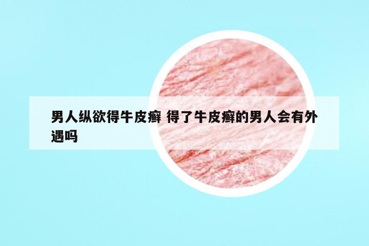 男人纵欲得牛皮癣 得了牛皮癣的男人会有外遇吗
