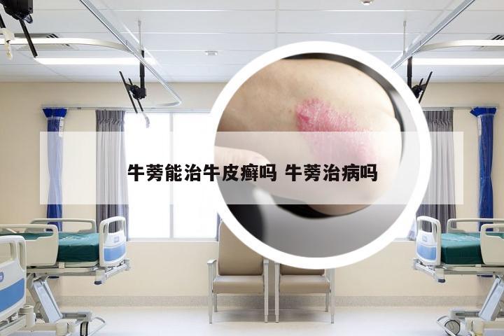 牛蒡能治牛皮癣吗 牛蒡治病吗