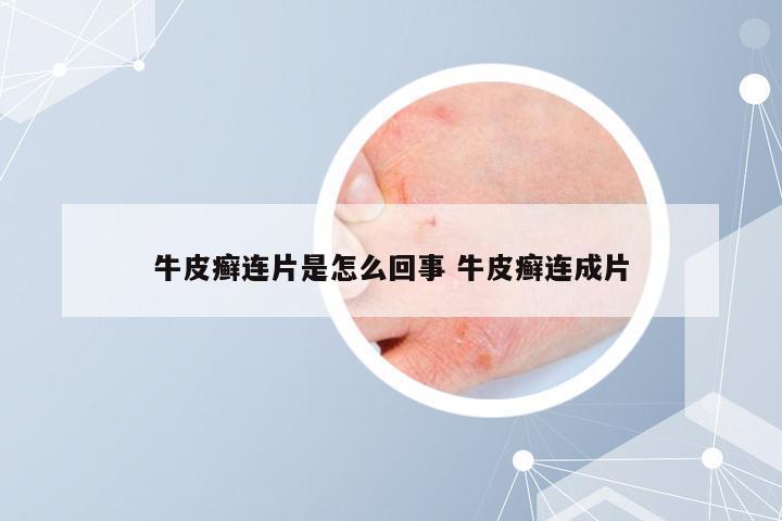 牛皮癣连片是怎么回事 牛皮癣连成片