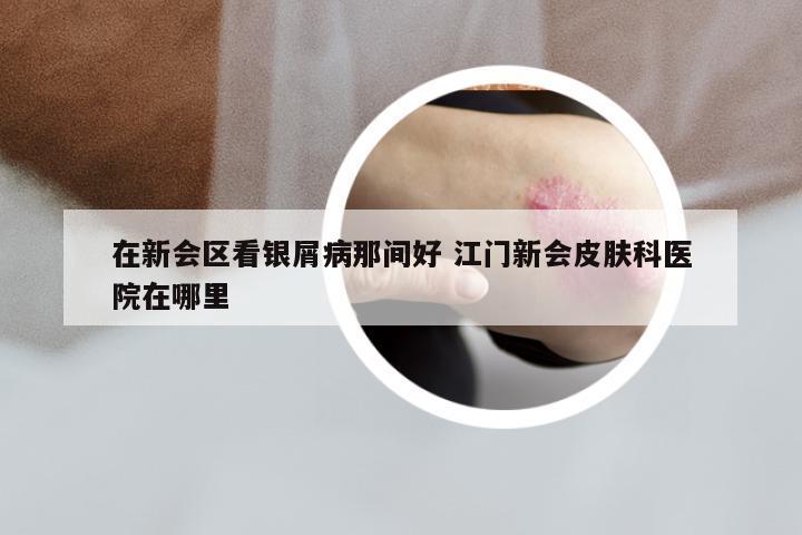 在新会区看银屑病那间好 江门新会皮肤科医院在哪里