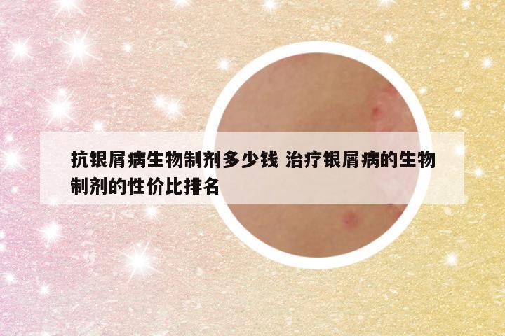 抗银屑病生物制剂多少钱 治疗银屑病的生物制剂的性价比排名