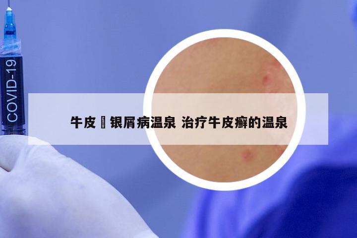 牛皮癬银屑病温泉 治疗牛皮癣的温泉