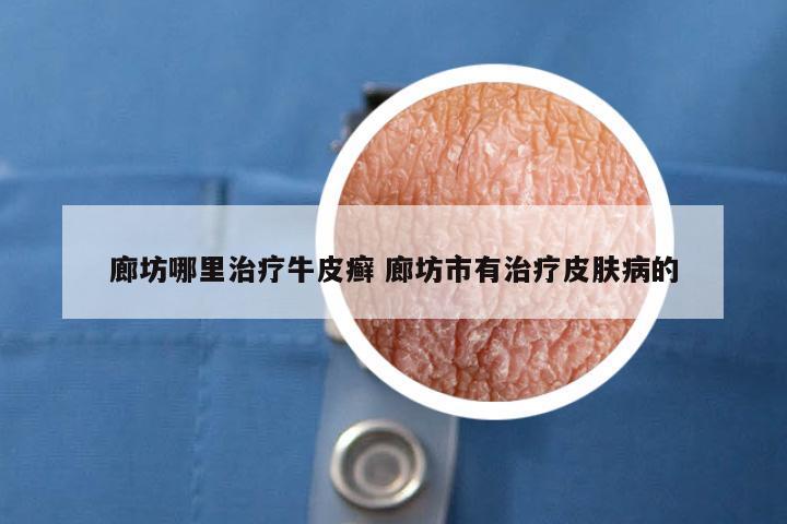 廊坊哪里治疗牛皮癣 廊坊市有治疗皮肤病的