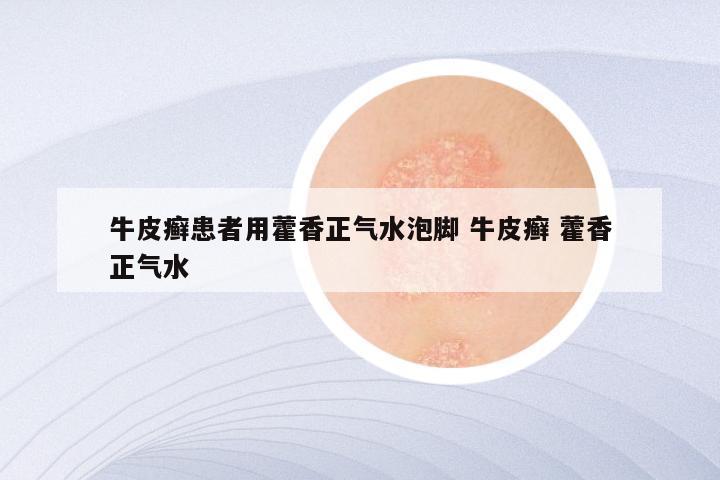 牛皮癣患者用藿香正气水泡脚 牛皮癣 藿香正气水