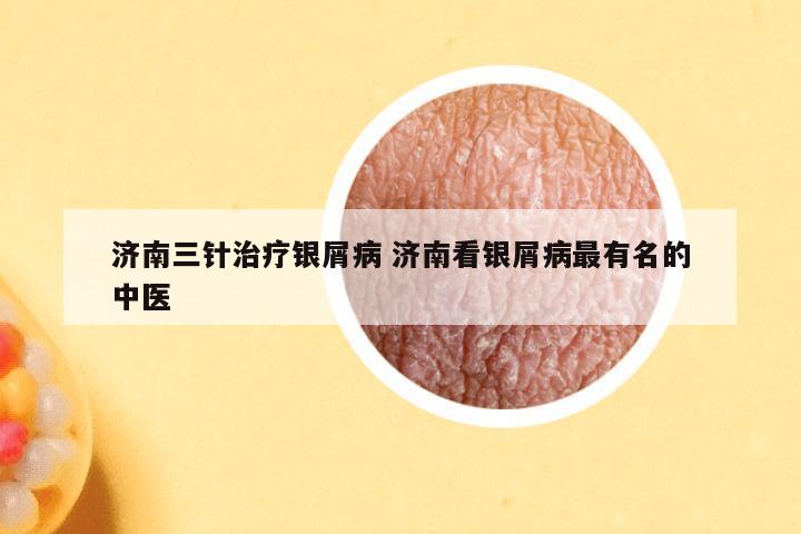 济南三针治疗银屑病 济南看银屑病最有名的中医