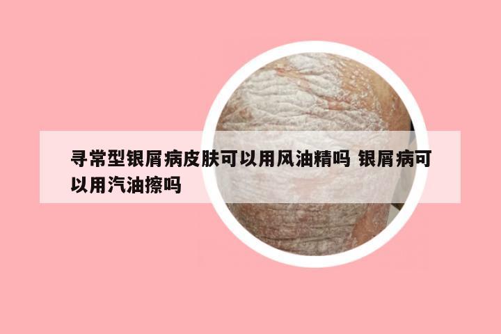 寻常型银屑病皮肤可以用风油精吗 银屑病可以用汽油擦吗