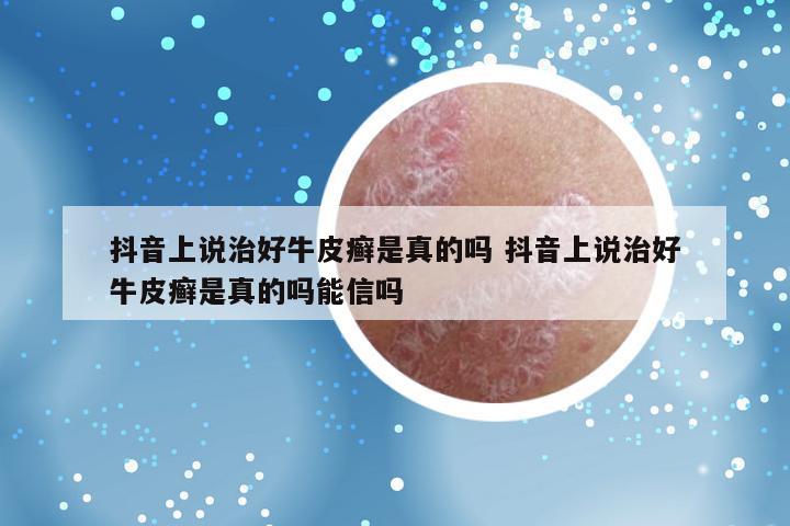 抖音上说治好牛皮癣是真的吗 抖音上说治好牛皮癣是真的吗能信吗