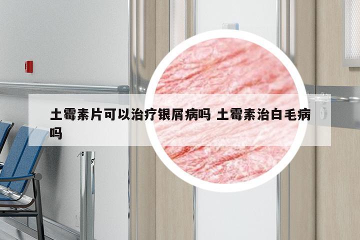 土霉素片可以治疗银屑病吗 土霉素治白毛病吗