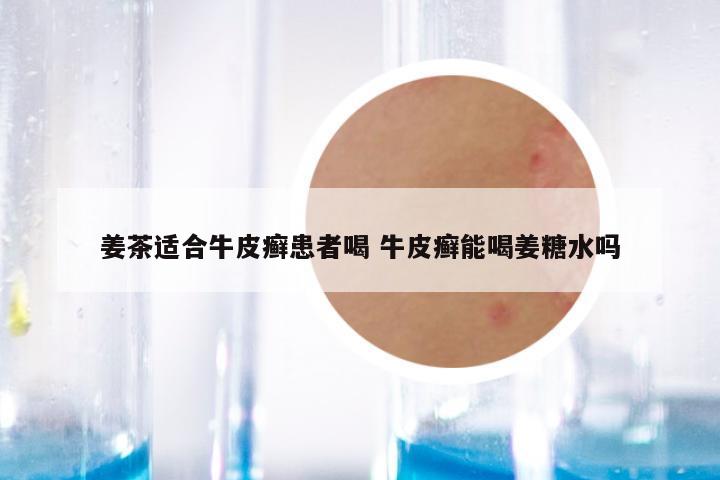 姜茶适合牛皮癣患者喝 牛皮癣能喝姜糖水吗