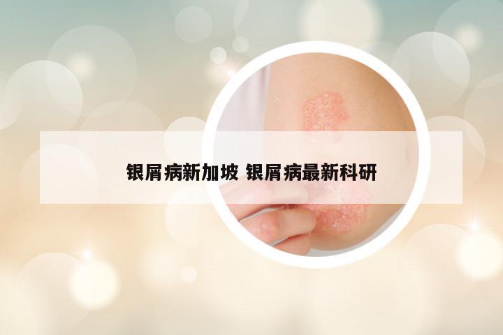 银屑病新加坡 银屑病最新科研
