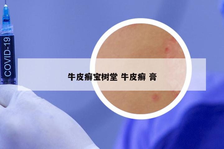 牛皮癣宝树堂 牛皮癣 膏