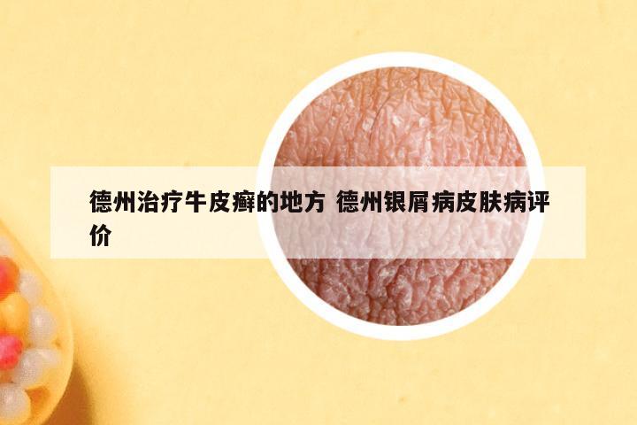 德州治疗牛皮癣的地方 德州银屑病皮肤病评价