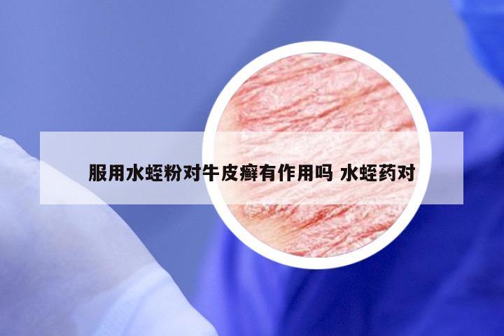服用水蛭粉对牛皮癣有作用吗 水蛭药对