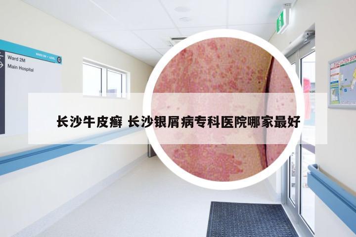 长沙牛皮癣 长沙银屑病专科医院哪家最好