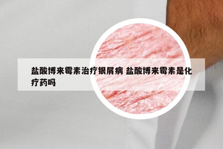 盐酸博来霉素治疗银屑病 盐酸博来霉素是化疗药吗