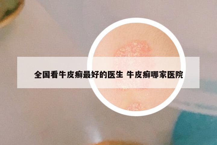 全国看牛皮癣最好的医生 牛皮癣哪家医院