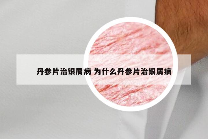 丹参片治银屑病 为什么丹参片治银屑病