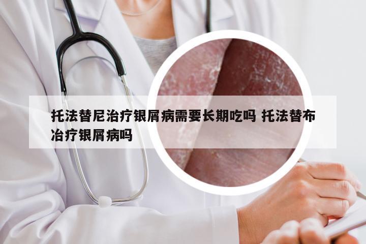 托法替尼治疗银屑病需要长期吃吗 托法替布冶疗银屑病吗