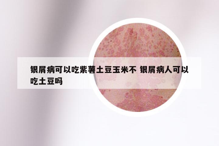银屑病可以吃紫薯土豆玉米不 银屑病人可以吃土豆吗