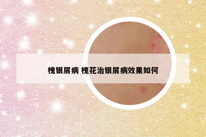 槐银屑病 槐花治银屑病效果如何