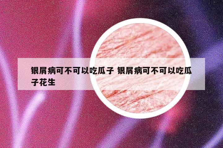 银屑病可不可以吃瓜子 银屑病可不可以吃瓜子花生