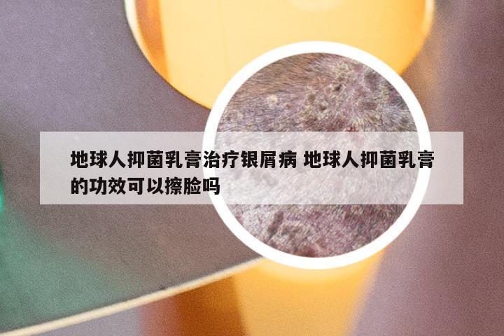 地球人抑菌乳膏治疗银屑病 地球人抑菌乳膏的功效可以擦脸吗