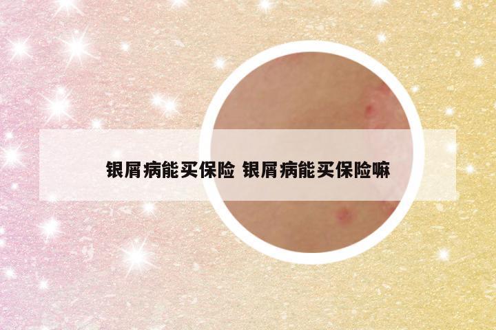 银屑病能买保险 银屑病能买保险嘛