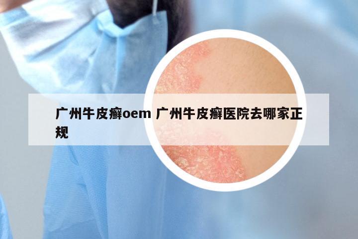 广州牛皮癣oem 广州牛皮癣医院去哪家正规