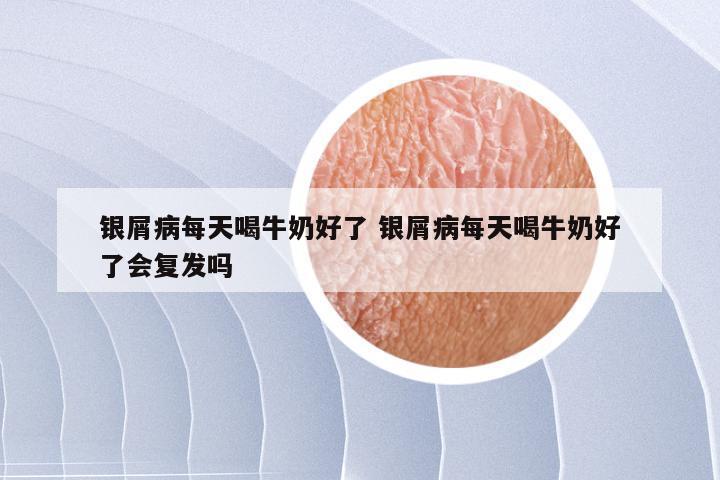 银屑病每天喝牛奶好了 银屑病每天喝牛奶好了会复发吗