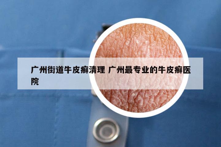 广州街道牛皮癣清理 广州最专业的牛皮癣医院