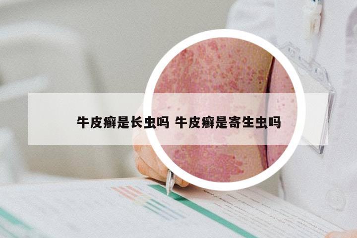 牛皮癣是长虫吗 牛皮癣是寄生虫吗